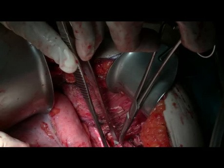 Tratamiento quirúrgico supramesocólico del pseudomixoma peritoneo