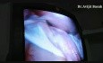Enorme quiste ovárico retorcido en el embarazo manejado por vía laparoscópica