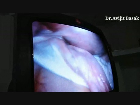 Enorme quiste ovárico retorcido en el embarazo manejado por vía laparoscópica