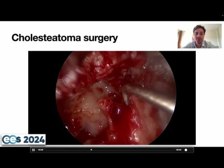 Colesteatoma en el espacio mesotímpánico. ¿Cómo manejar un nervio facial dehiscente?
