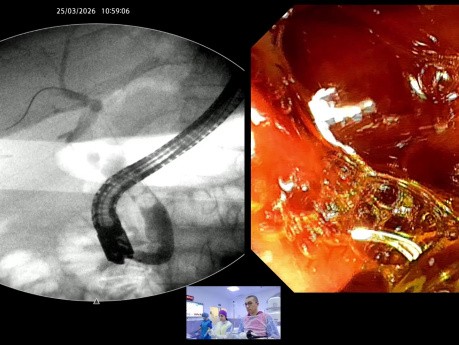 Dominando el CBD distal: la maniobra de "bulbo restringido" para una EPLBD segura.
