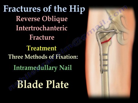 Fracturas de cadera y su fijación