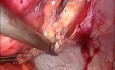 Hernioplastia por técnica IPOM Plus