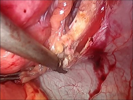 Hernioplastia por técnica IPOM Plus