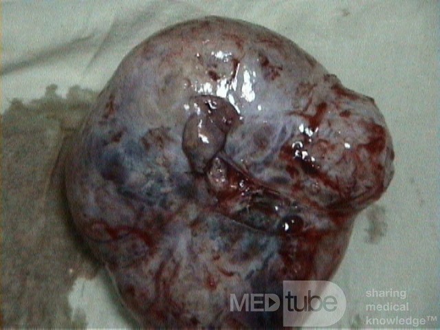 Arrenoblastoma 