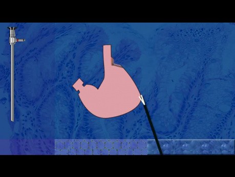 Gastroplastia laparoscópica de Wedge-Collis durante fundoplicatura de 360 ° y reparación de hernia de hiato
