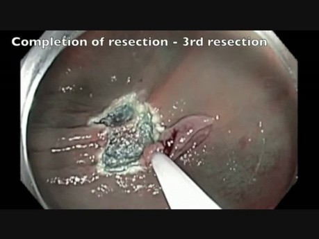 Perforación del colon tras RME - G