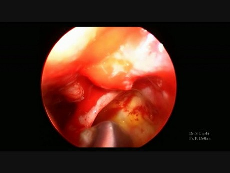 Sinequias después de la radioterapia por un carcinoma nasofaríngeo indiferenciado