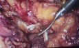 Hemicolectomia derecha laparoscopica en UN paciente con nm colon derecho estenosante t4n3m2
