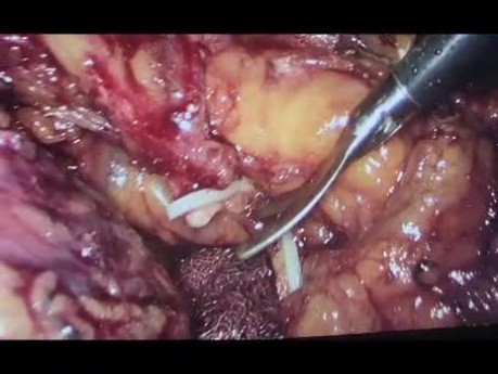 Hemicolectomia derecha laparoscopica en UN paciente con nm colon derecho estenosante t4n3m2
