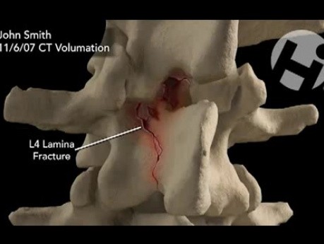 Columna lumbar antes y después de la cirugía