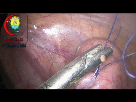 Para evitar la apendicitis del muñón