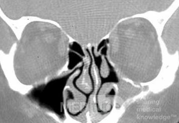 Sinusitis micótica [tomografía computarizada]