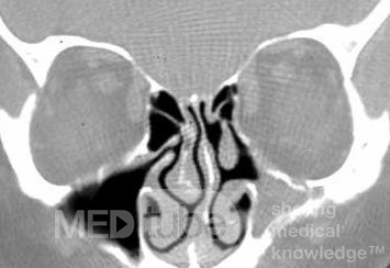 Sinusitis micótica [tomografía computarizada]