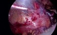 Tratamiento laparoscópico TEP de la hernia inguinal derecha