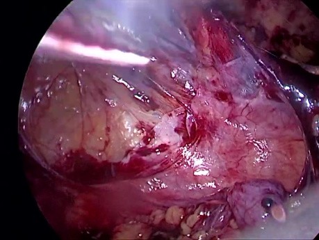 Tratamiento laparoscópico TEP de la hernia inguinal derecha