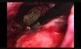 Necrosectomía pancreática laparoscópica