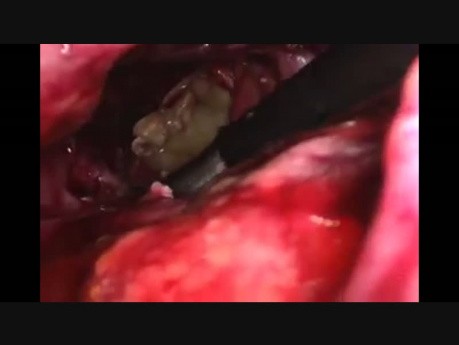 Necrosectomía pancreática laparoscópica