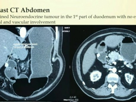Resección laparoscópica transduodenal del tumor neuroendocrino duodenal