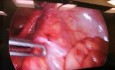 Laparoscopia para asa intestinal estrangulada en el ligamento ancho uterino