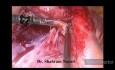 Laparoscopia de la apendicitis supurativa aguda