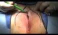 Video de levantamiento de hendidura - cirugía pilonidal