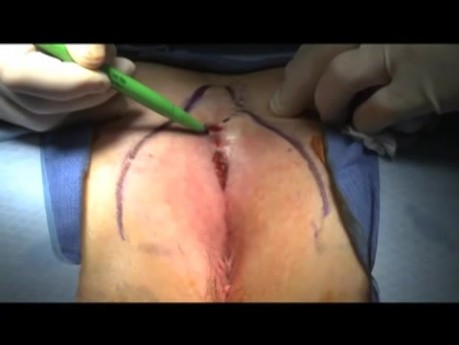 Video de levantamiento de hendidura - cirugía pilonidal