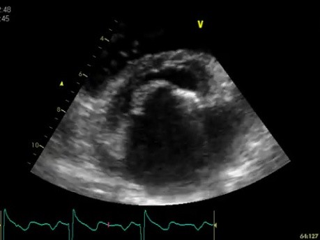 Estenosis de la válvula mitral causada por cardiopatía reumática
