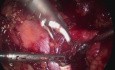 Disección laparoscópica de ganglios linfáticos para la recurrencia del cáncer de próstata