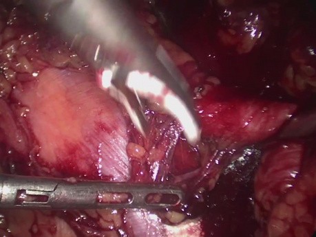 Disección laparoscópica de ganglios linfáticos para la recurrencia del cáncer de próstata