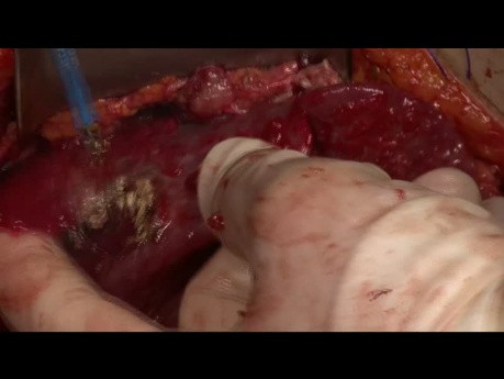 Aspectos quirúrgicos del pseudomixoma peritoneo