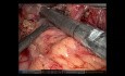 Esofagectomía transhiatal robótica para el adenocarcinoma localmente avanzado