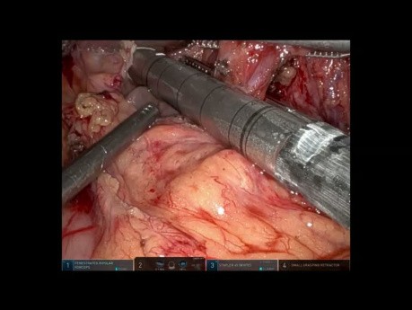 Esofagectomía transhiatal robótica para el adenocarcinoma localmente avanzado