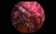 Reparación laparoscópica de hernia L4 izquierda preperitoneal transabdominal