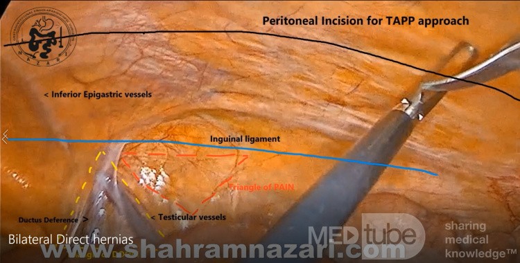 Puntos de referencia para la reparación laparoscópica de hernia TAPP