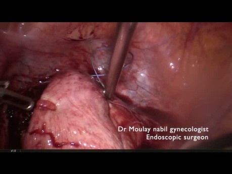 Miomectomía con control vascular transitorio