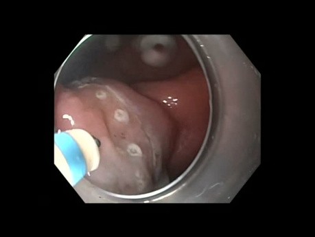 Tratamiento del cáncer de estómago temprano