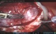 Excisión bilateral de endometriomas