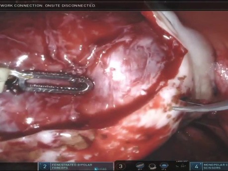 Excisión bilateral de endometriomas