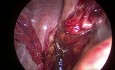SILS utilizando un retractor magnético en resección anterior baja