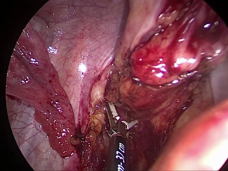 SILS utilizando un retractor magnético en resección anterior baja