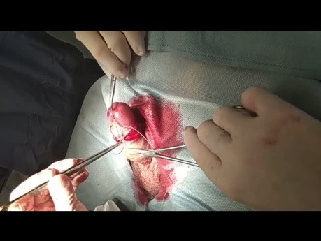 Técnica de circuncisión en fimosis adquirida con la pinza de Emil Theodor Kocher (Profilaxis del Cáncer de pene)