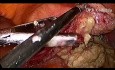Miomectomía y quistectomia del quiste dermoide de ovario por vía laparoscópica