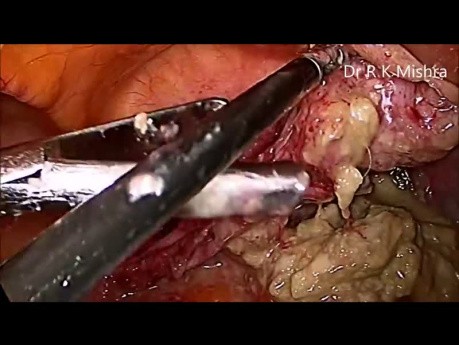 Miomectomía y quistectomia del quiste dermoide de ovario por vía laparoscópica