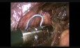 Duodenopancreatectomía laparoscópica asistida por ampuloma vateriano en un paciente obeso