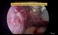 Histerectomía laparoscópica total de un útero fibroide utilizando un dispositivo de energía híbrida