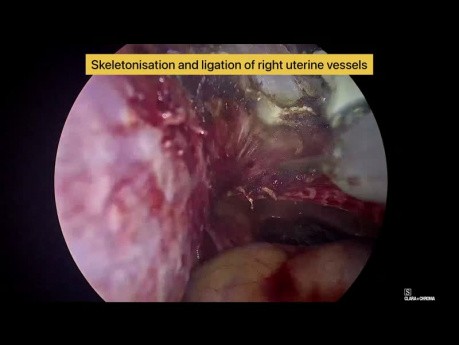 Histerectomía laparoscópica total de un útero fibroide utilizando un dispositivo de energía híbrida