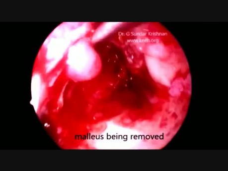 Descompresión e injerto del nervio facial derecho