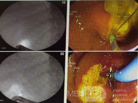 Quiste hidatídico hepático, CBC y colangitis, extracción de quiste hijo con CPRE