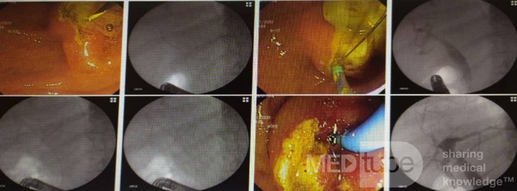 Quiste hidatídico hepático, CBC y colangitis, extracción de quiste hijo con CPRE